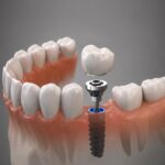 Discover how dental implants work, their benefits, procedure, recovery, and cost. Explore dental implant options at Roots Medical Centre in Al Nahda, Sharjah.