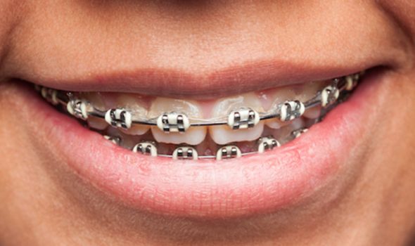 Are you considering orthodontic treatmen